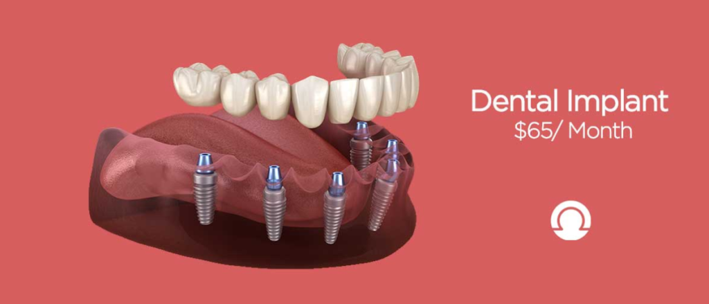 All on 4 Dental Implants: Comprehensive Guide