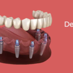 All on 4 Dental Implants: Comprehensive Guide